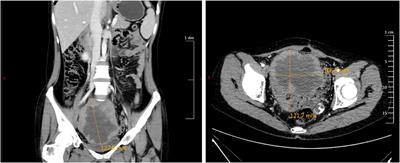 Recurrent mucinous carcinoma with sarcomatoid and sarcomatous mural nodules: a case report and literature review